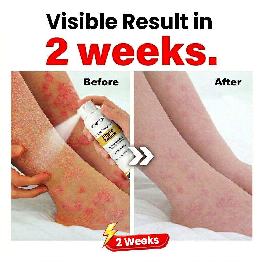 KUBOZN® Phyto Tallow Spray for Psoriasis-Prone Skin💓