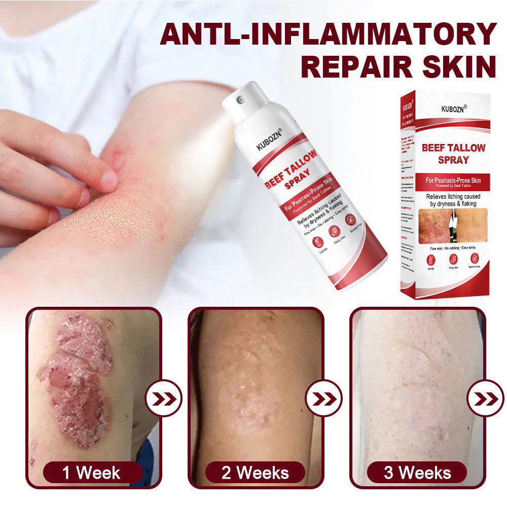 KUBOZN® Tallow Spray — The No-Rub Relief for Psoriasis-Prone Skin✨ (OFFER)